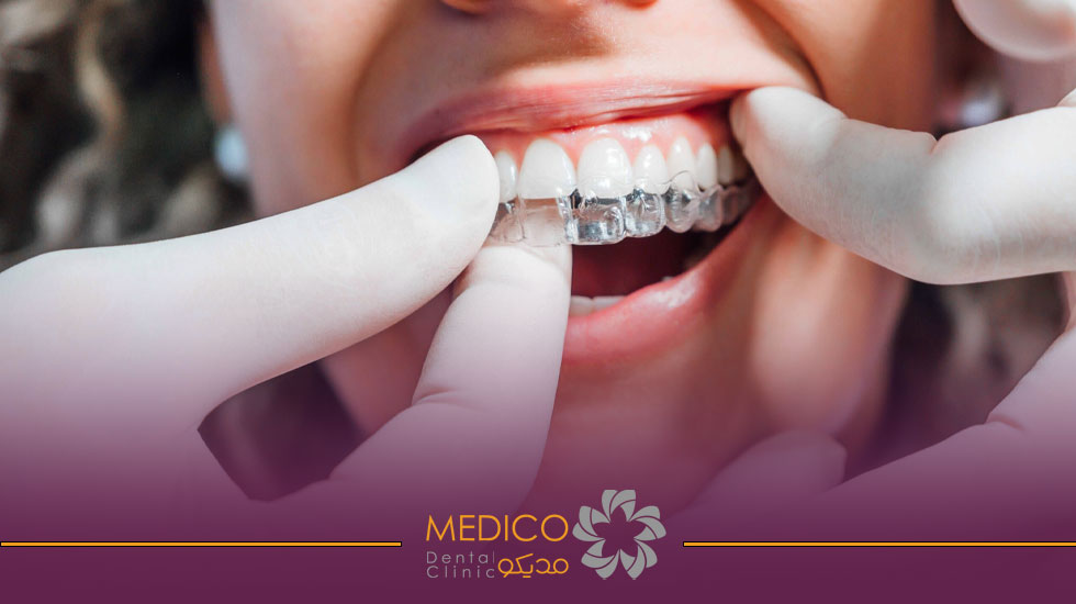 ارتودنسی نامرئی