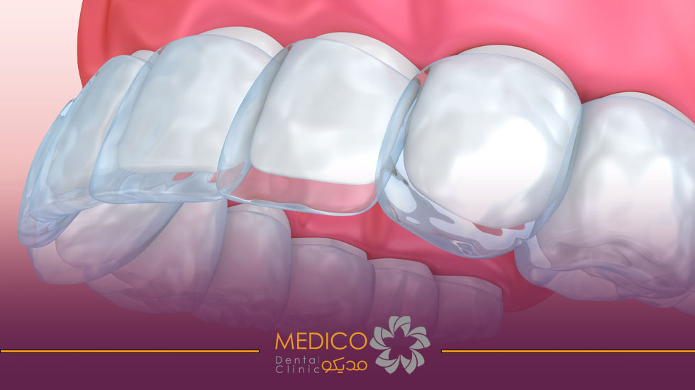 Invisible orthodontics