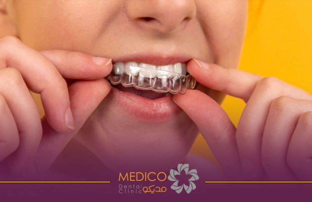 ارتودنسی نامرئی (الاینر)