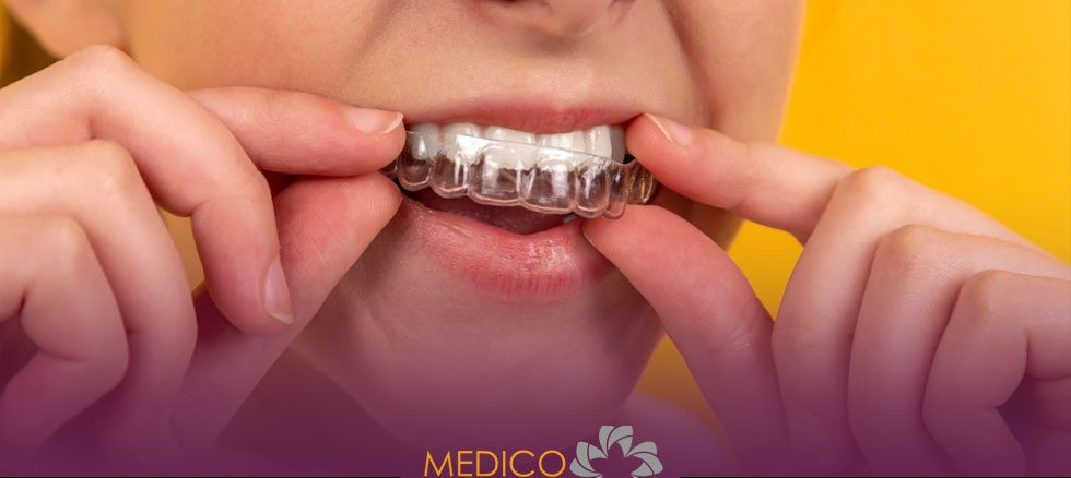 ارتودنسی نامرئی (الاینر)