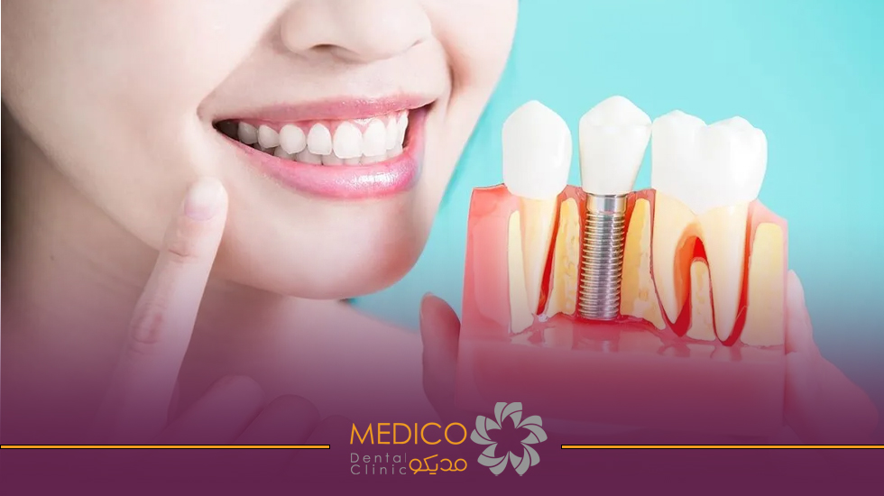 ایمپلنت دندان چیست؟