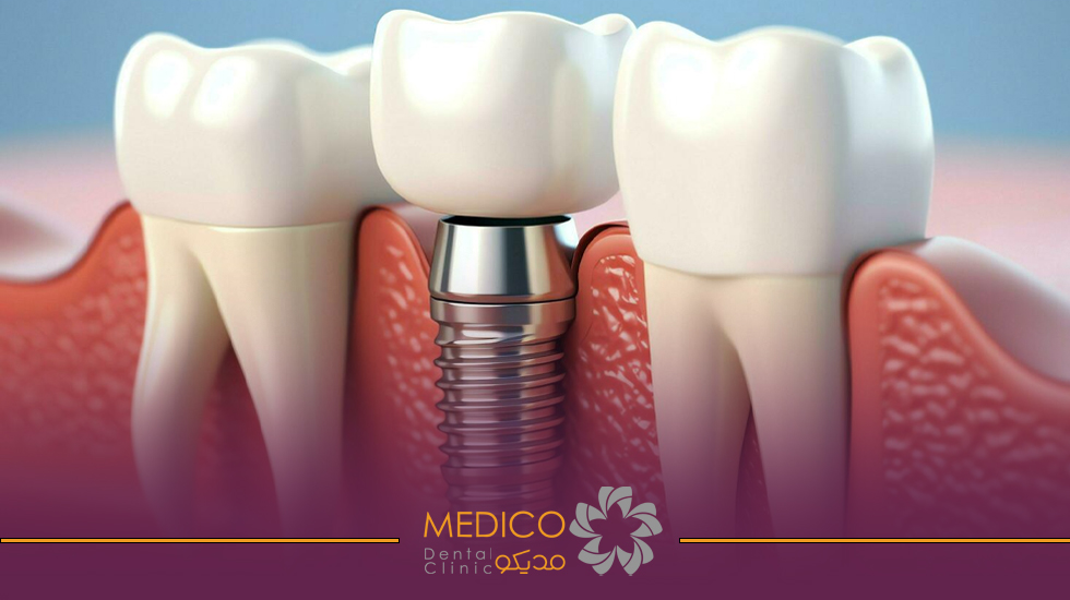 ایمپلنت دندان