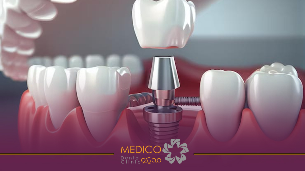 Dental implants