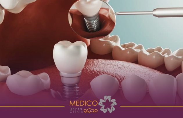 ایمپلنت دندان