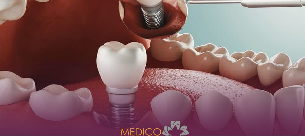 ایمپلنت دندان