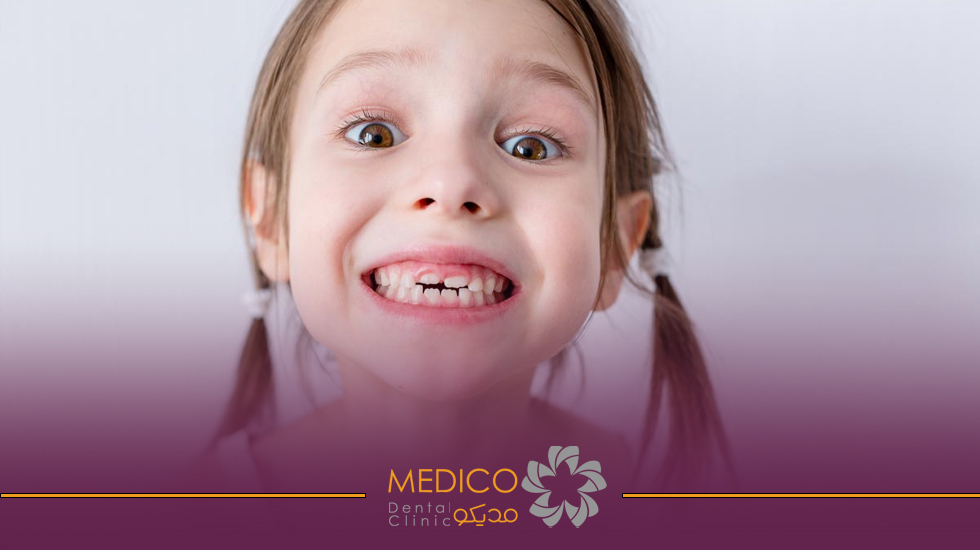 دندان های شیری