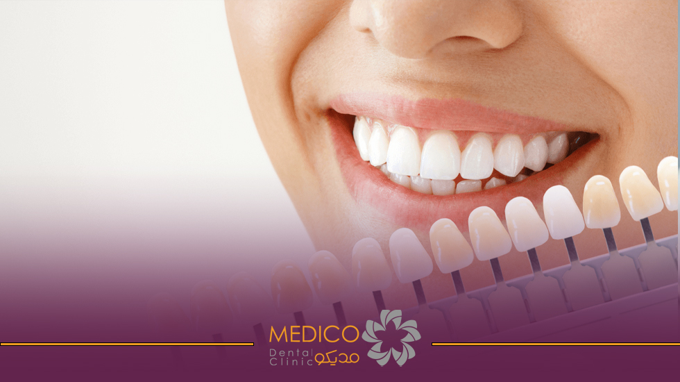 بلیچینگ دندان