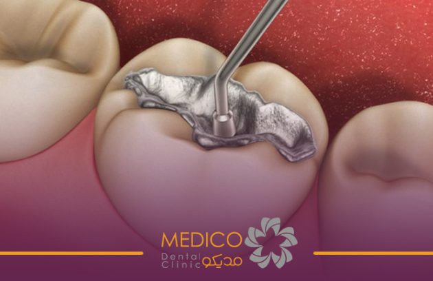 پرکردگی‌های آمالگام