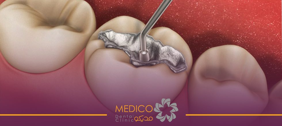 پرکردگی‌های آمالگام