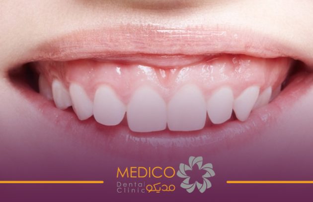 درمان لبخند لثه‌ای