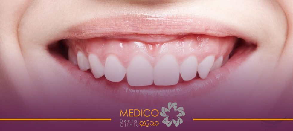 درمان لبخند لثه‌ای